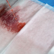 Sterile DryMax Maxi mat absorbs blood spills in Coronary Artery Bypass Graft surgery