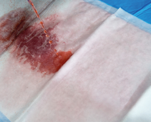 Sterile DryMax Maxi mat absorbs blood spills in Coronary Artery Bypass Graft surgery