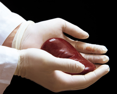 Kidney Transplant - absorbent sterile mats to keep surgeon's hands warm